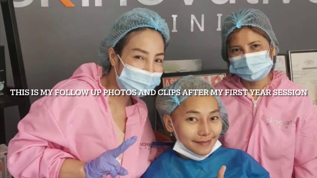 ONE WEEK FOLLOW UP AFTER INSERTING 10 HIKO THREADS FROM SKINOVATIVE CLINIC MAKATI PHILIPPINES REVIEW
