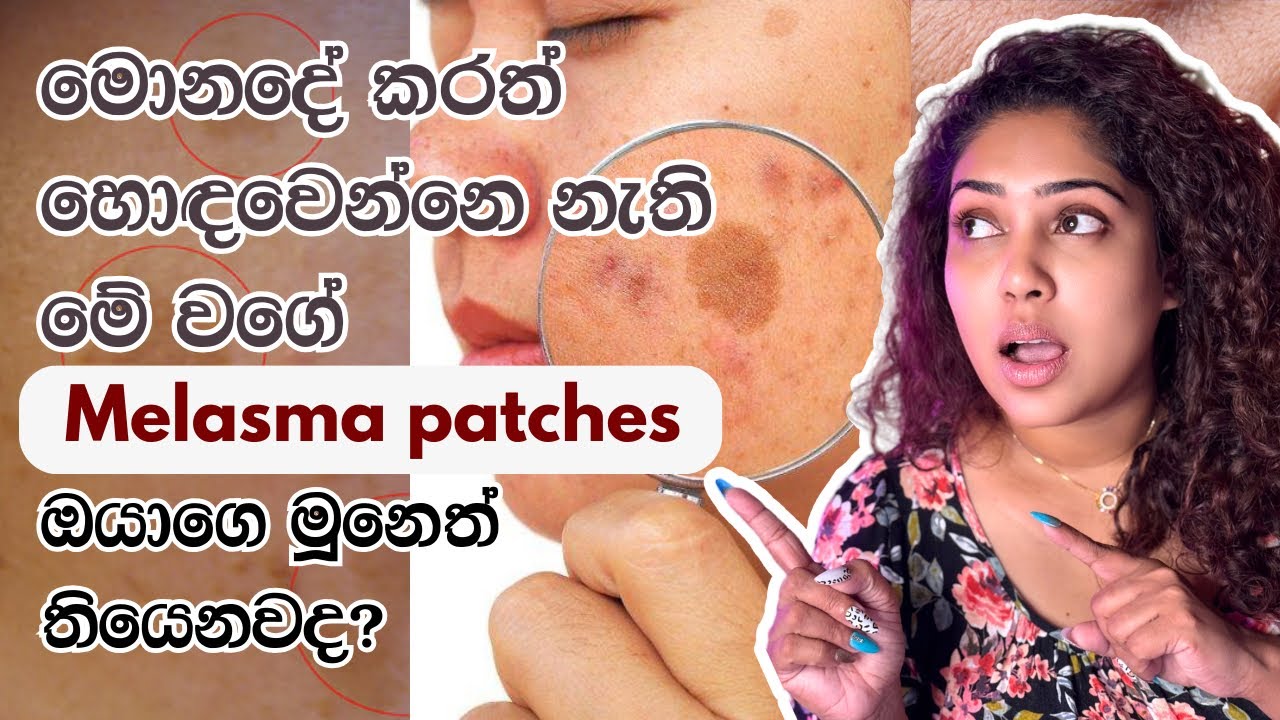 හොඳවෙන්නෙ නැති මේ වගේ Patches ඔයාගෙ මූනෙත් තියෙනවද? | All about Melasma