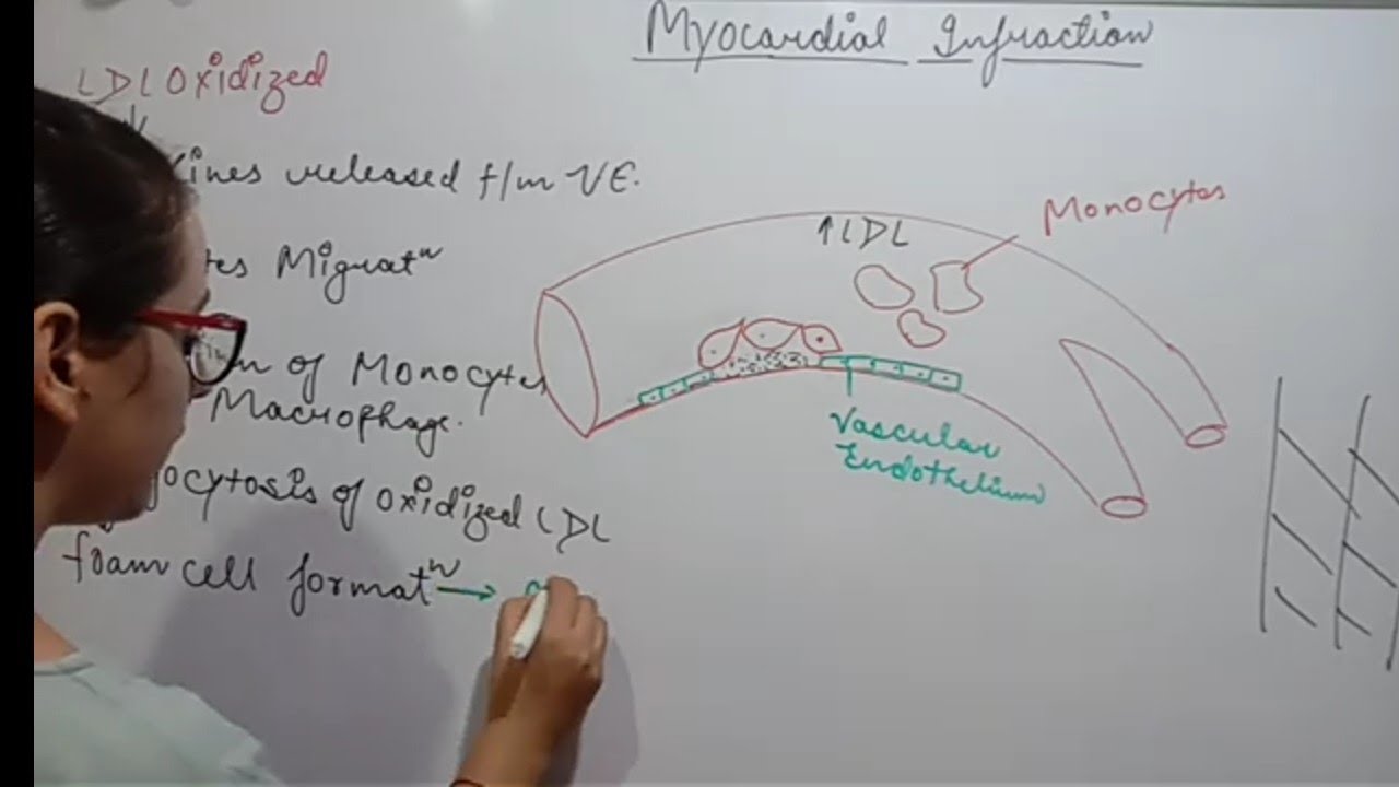 MYOCARDIAL INFRACTION | PART-1 | PATHOPHYSIOLOGY