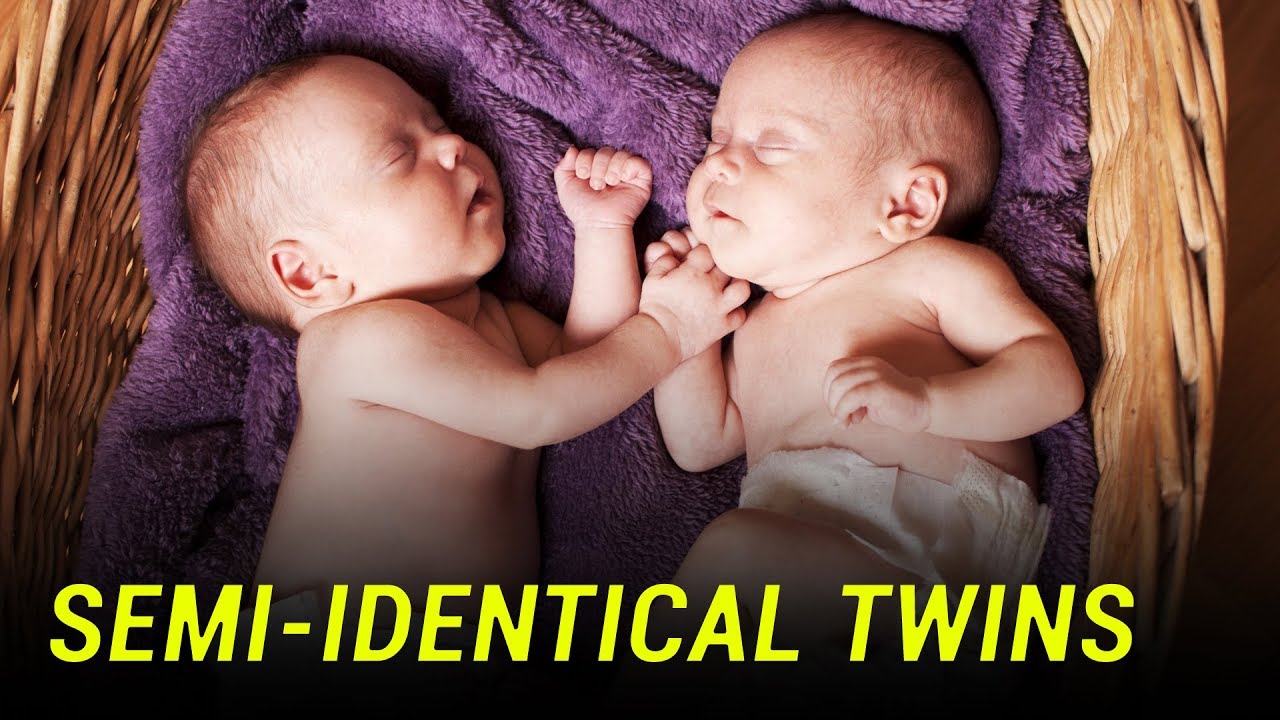 New type of twin born from one egg and two sperm