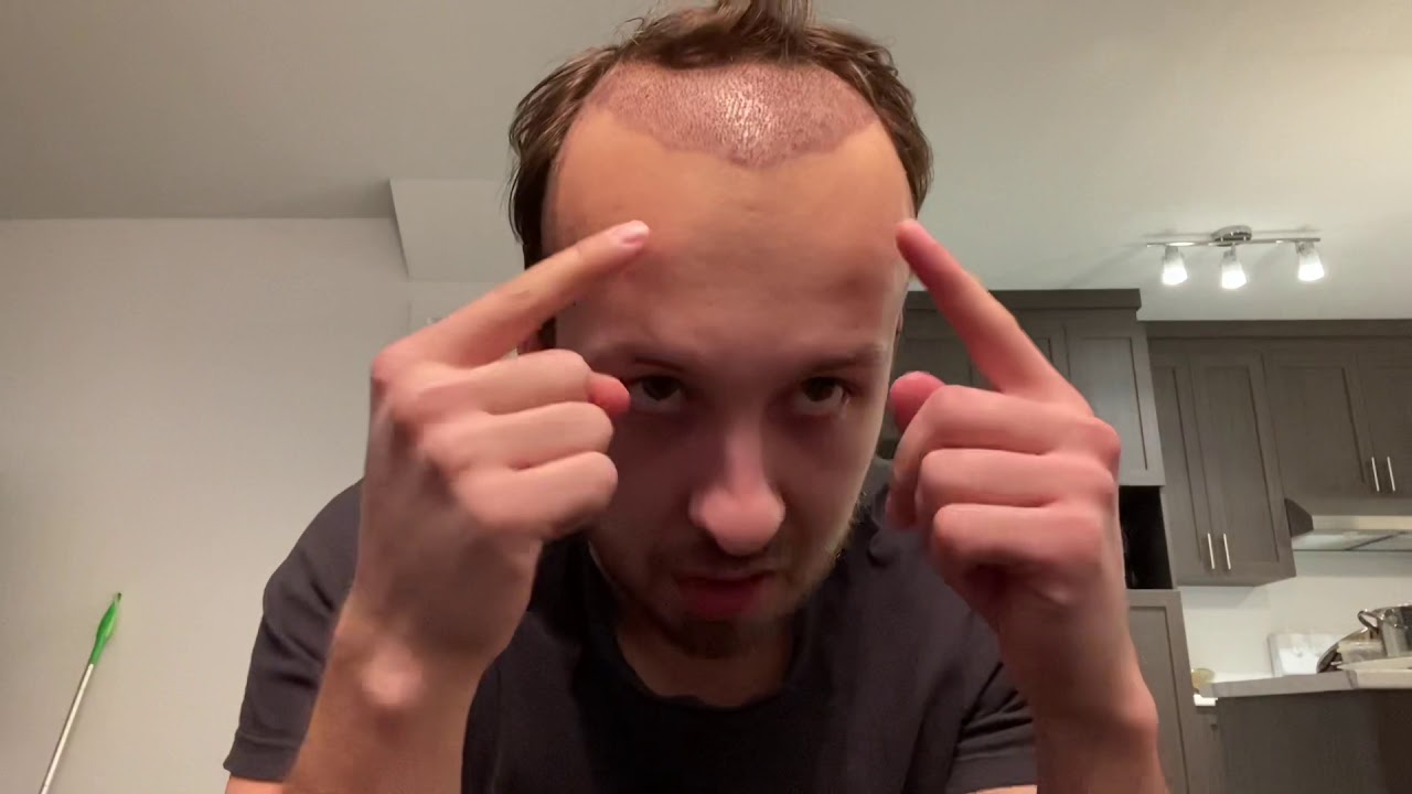 FUT RECOVERY day 5 post op @ Hasson and Wong review