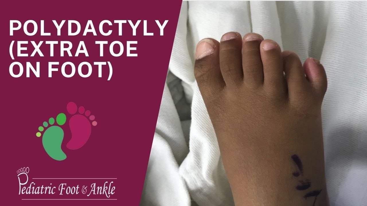 Polydactyly (ExtraToe On Foot)
