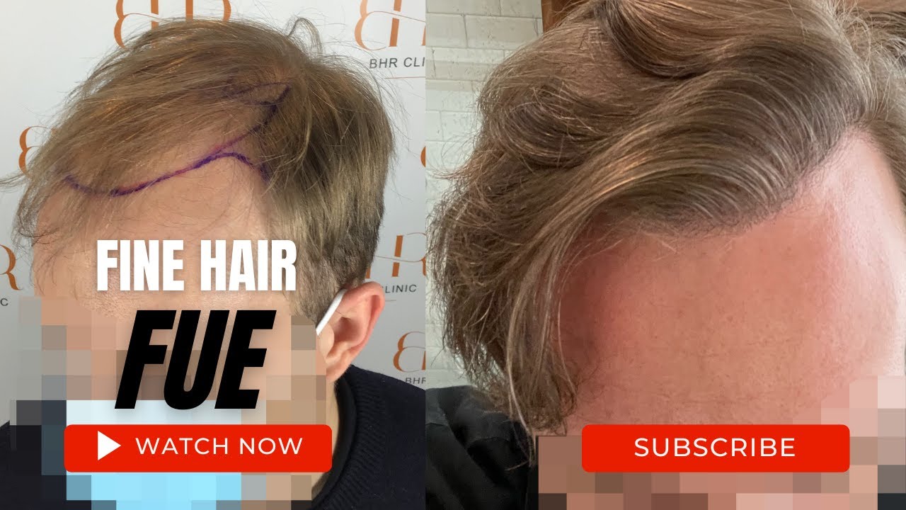 FUE Hair Transplant Results | Fine Haired Patient Documents Healing To Growth Timeline.
