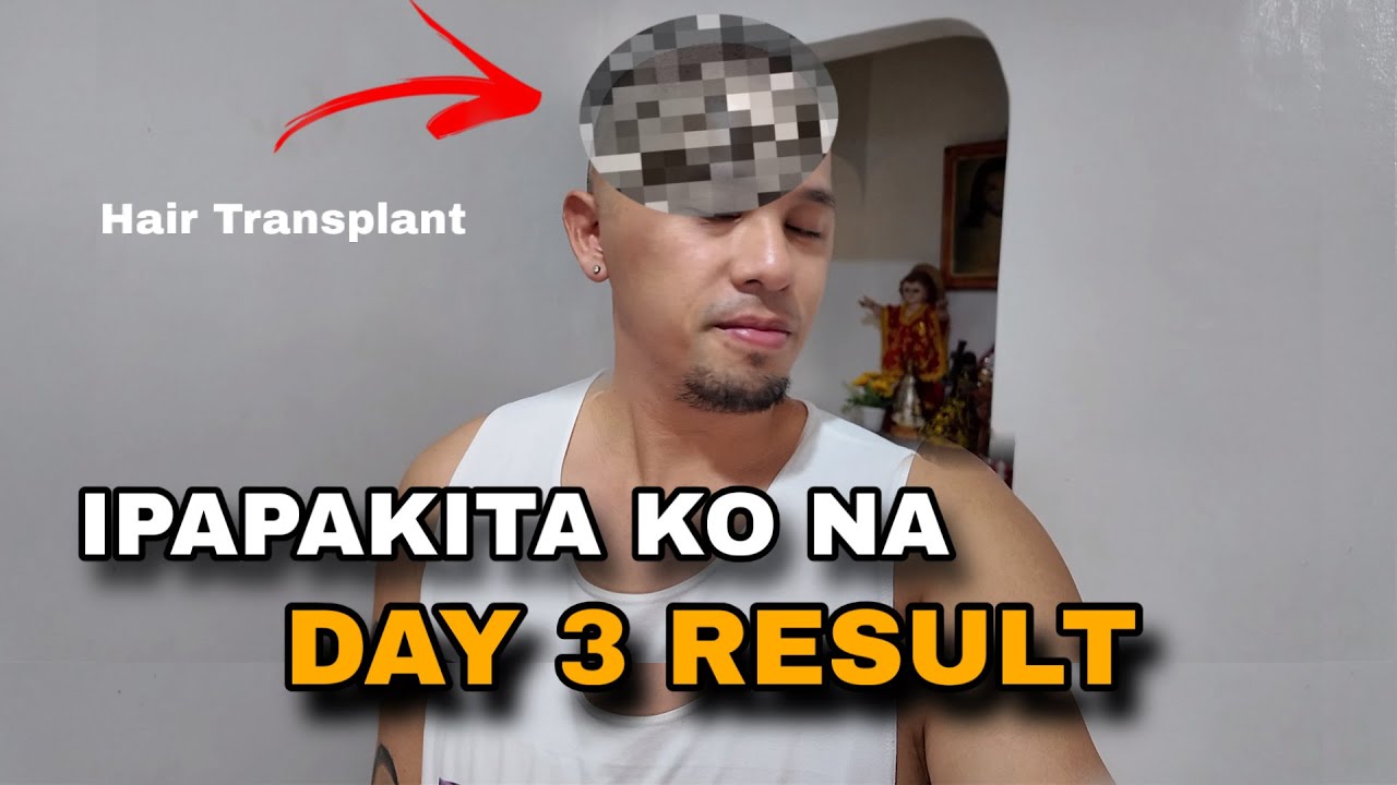 GRABE YUNG RESULTA NG HAIR TRANSPLANT | Pinas Vlog