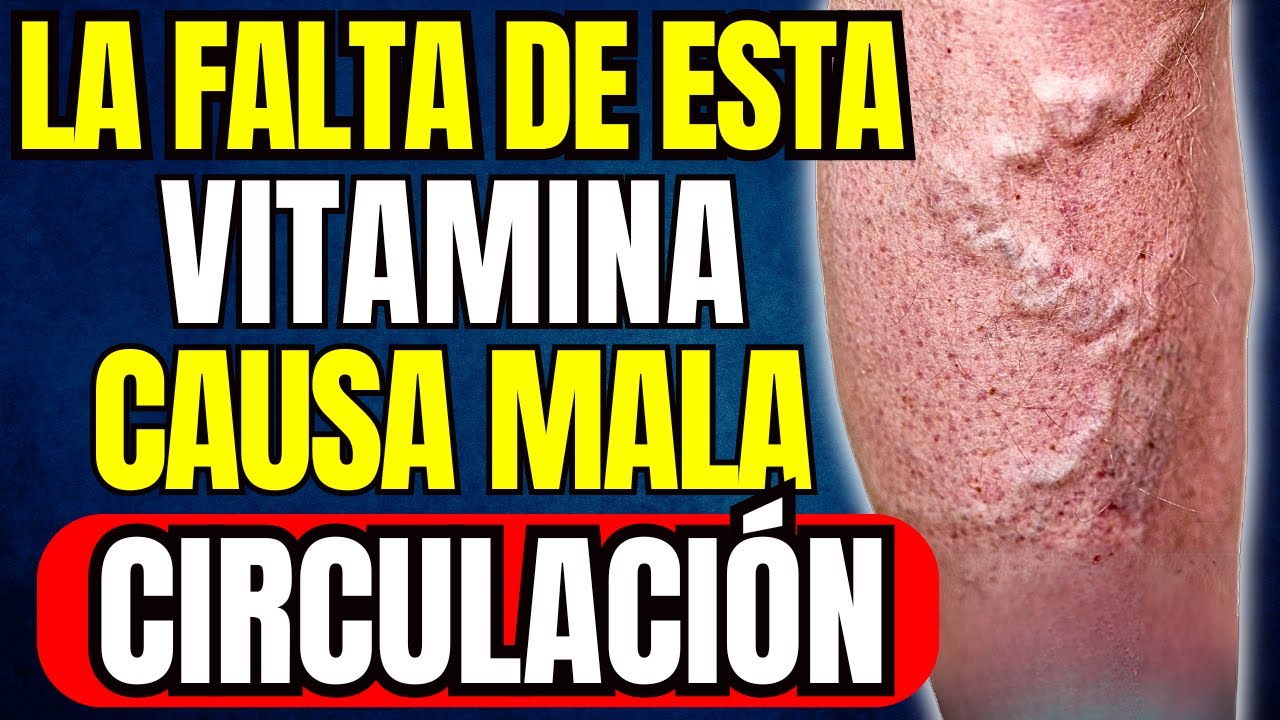 VARICES e INSUFICIENCIA VENOSA: La Vitamina NATURAL #1 (CÓMO TOMARLA)