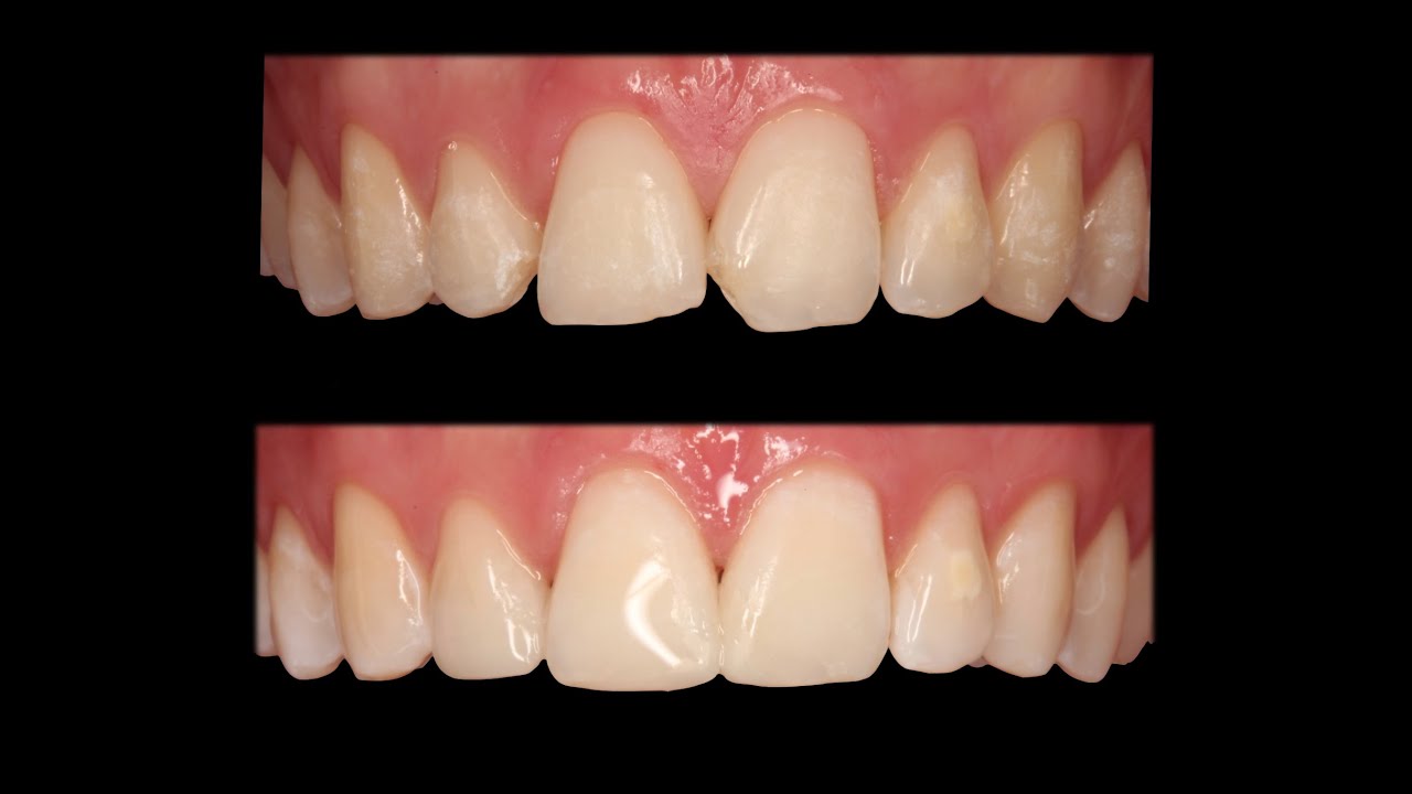 Dientes Adelantados, Avance Mandibular, Restauración Dientes Fracturados