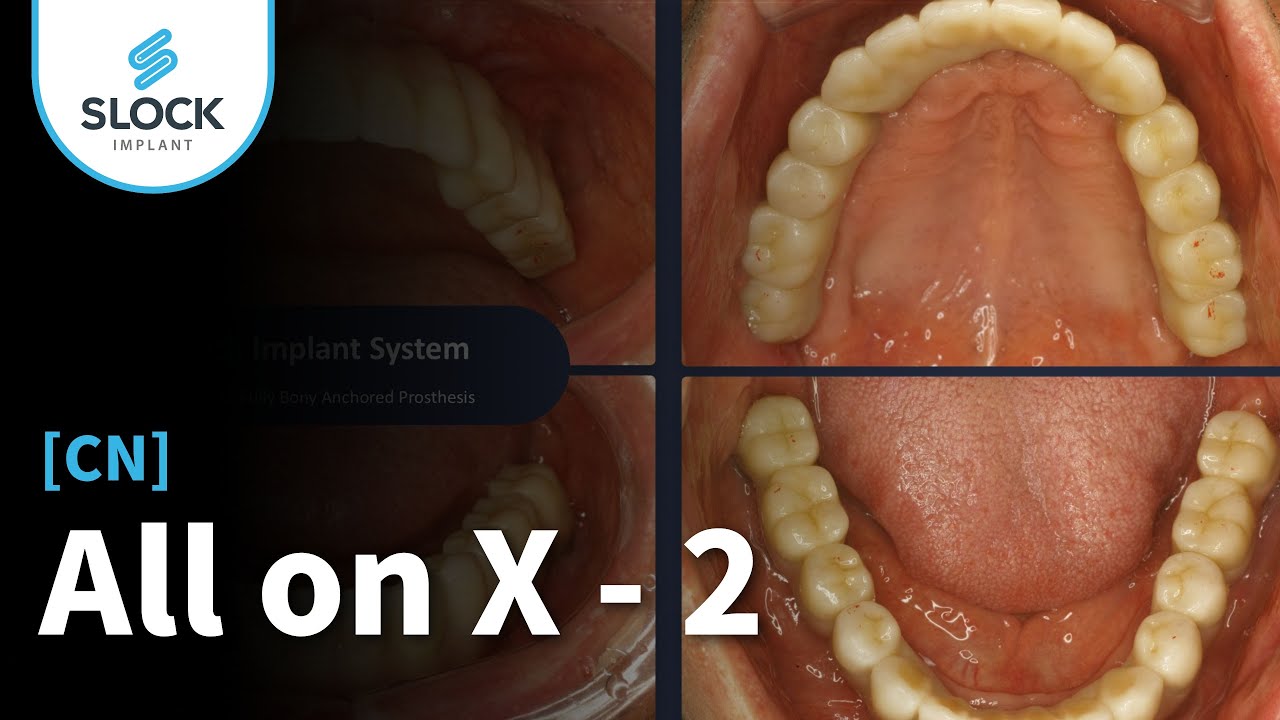 [CN] AllonX - 2