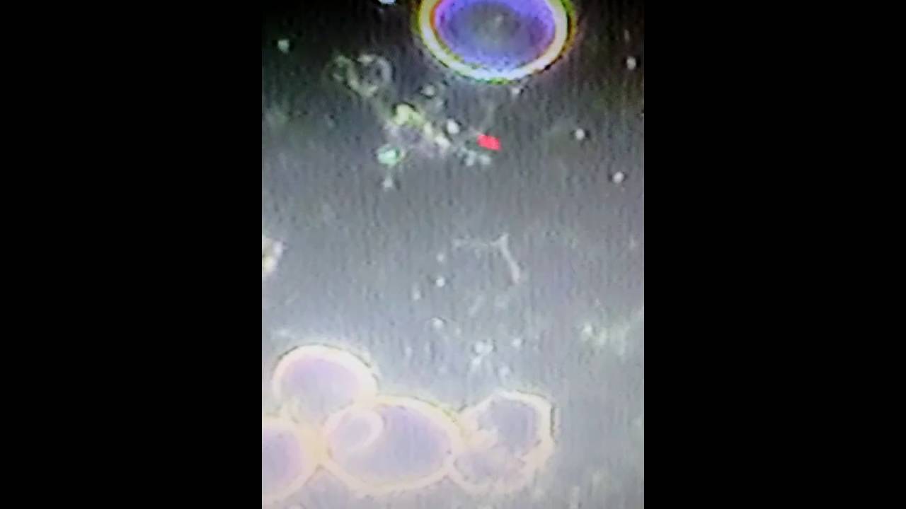 Live blood analysis showing Lyme spirochetes