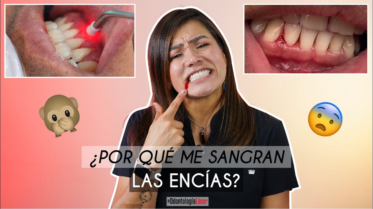 &iquest;Por qu&eacute; me sangran las enc&iacute;as? 🤔 &iquest;Es normal?🩸 &iquest;A que se debe el sangrado? - Odontolog&iacute;a L&aacute;ser.