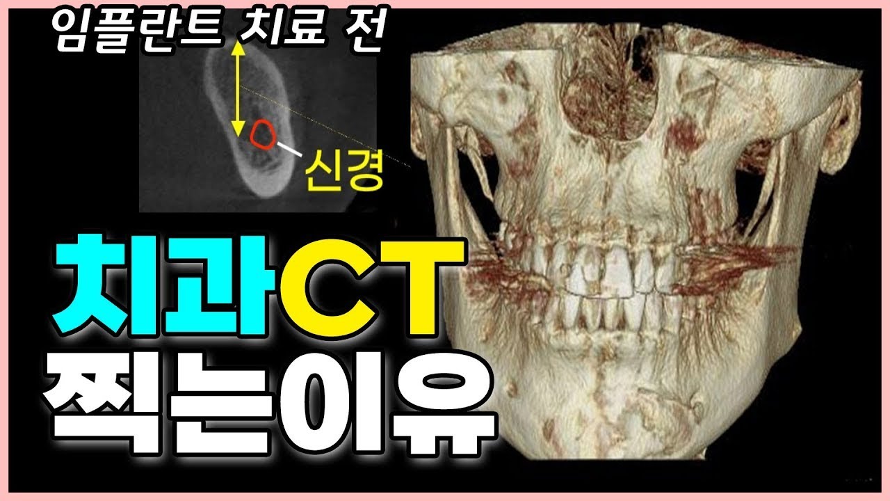 치과 CT 보는 법! 치과에서 CT 찍는 3가지 경우 자세히 알려드려요