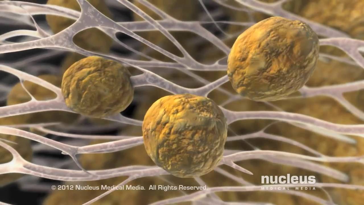 Asian Heart Hospital - What is Atherosclerosis?