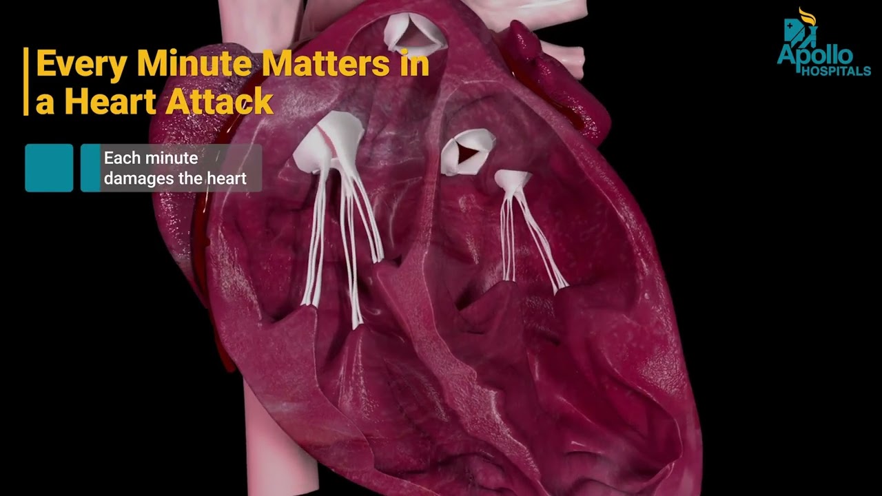 Angioplasty Explained | Symptoms, Procedure & Benefits