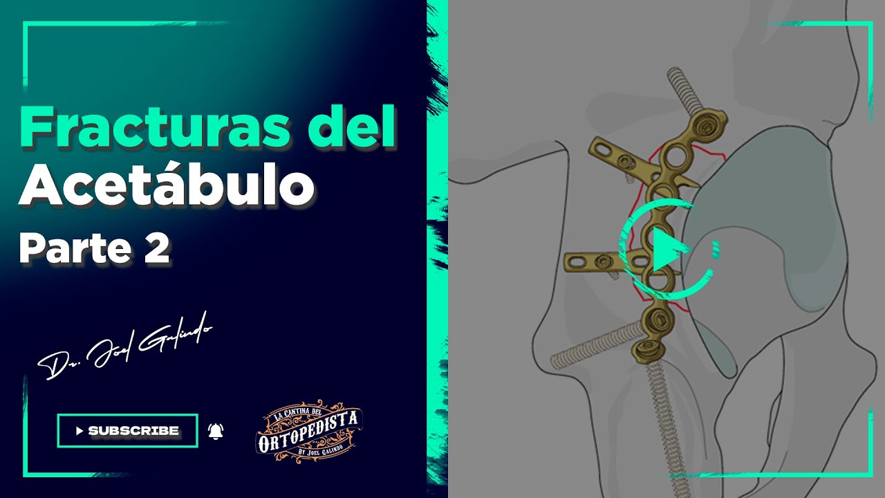 Fracturas del acetábulo | Segunda Parte