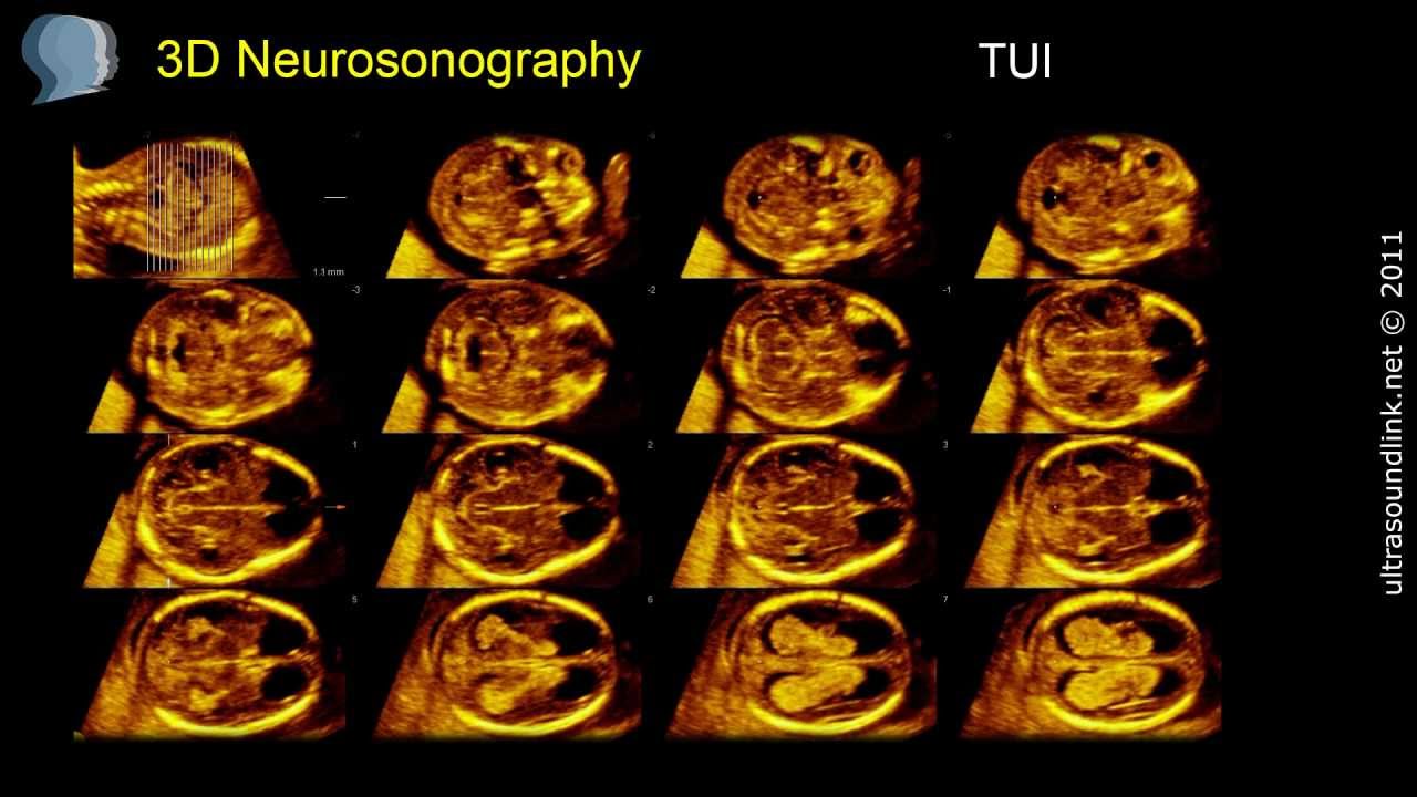 The 12 Weeks Scan: 3D and 4D Ultrasound