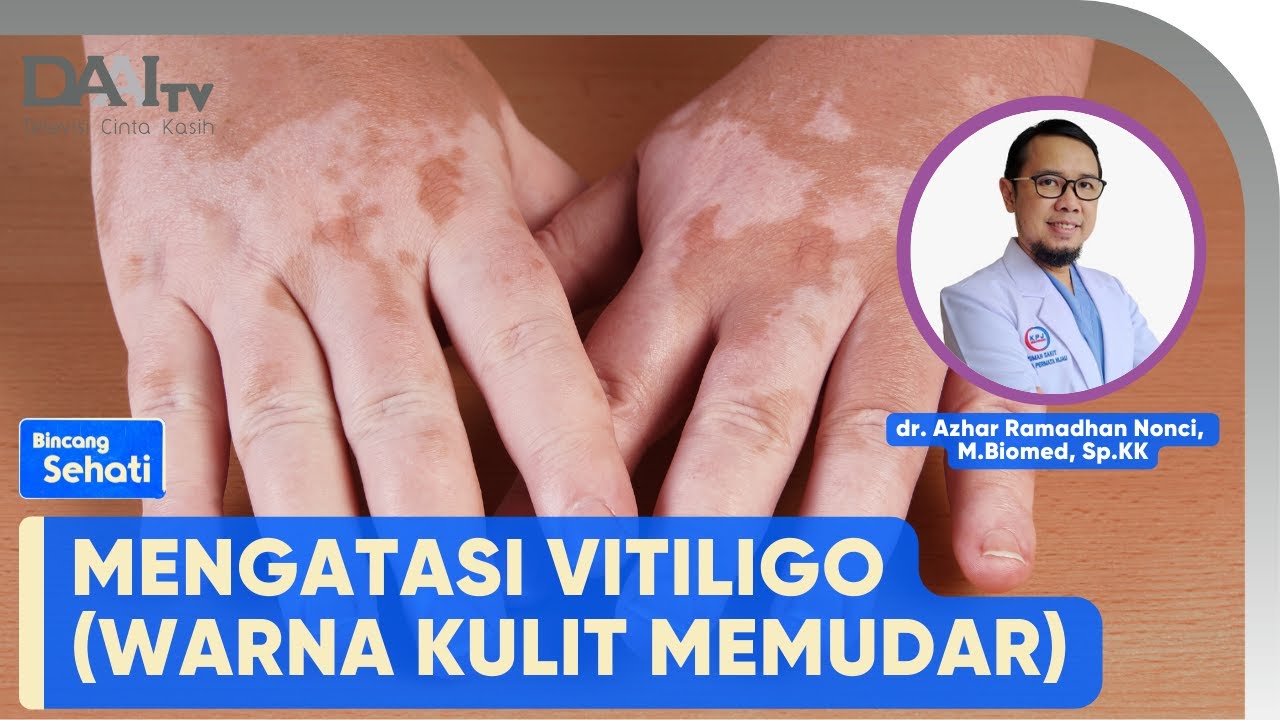 Mengatasi Vitiligo | Bincang Sehati