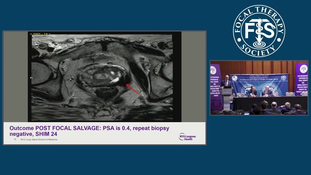 FTS 15 - Day 3 - Salvage Focal Therapy Post Radiation