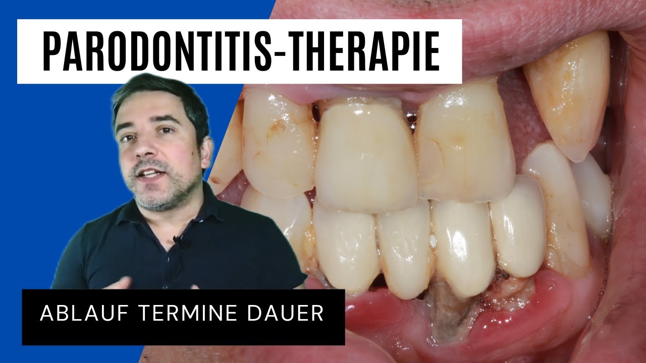 Parodontitistherapie / Zahnfleischbehandlung - Ablauf, Termine, Dauer nach den neuen Richtlinien