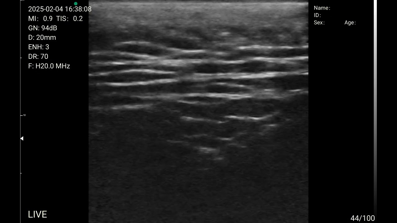 Forehead Ultrasound B-Mode Imaging with TodoPocus&trade; High-frequency Linear Probe L20