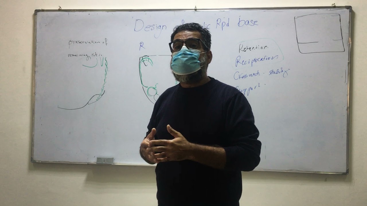 Designing of acrylic RPD (Mand Class II, Mod. 1)