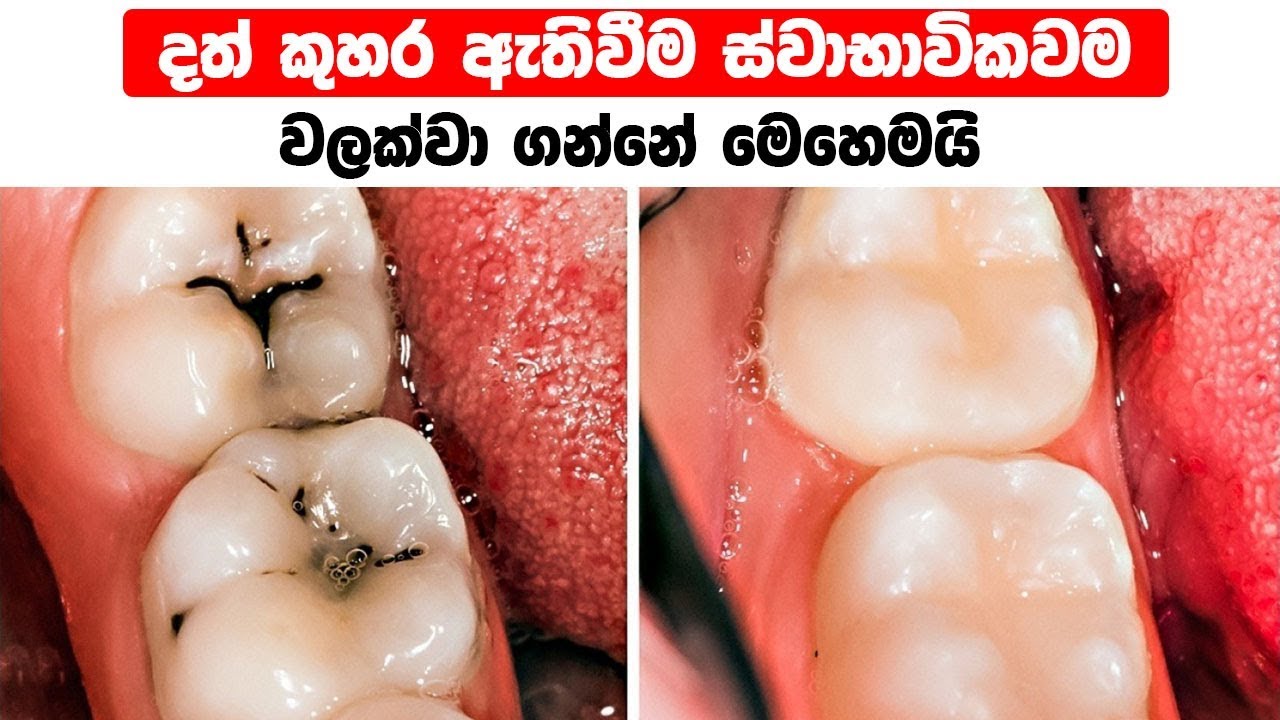 දත් කුහර ඇතිවීම ස්වාභාවිකවම වලක්වා ගන්නේ මෙහෙමයි