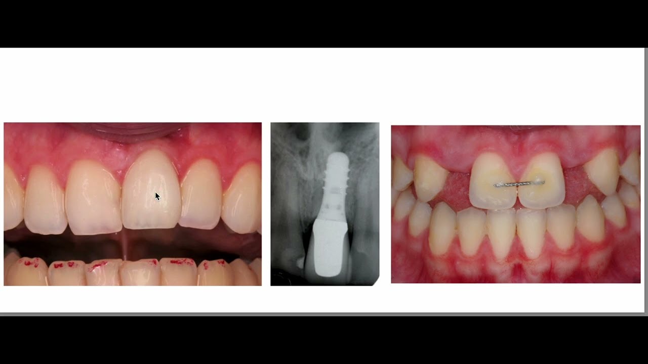 implant placement
