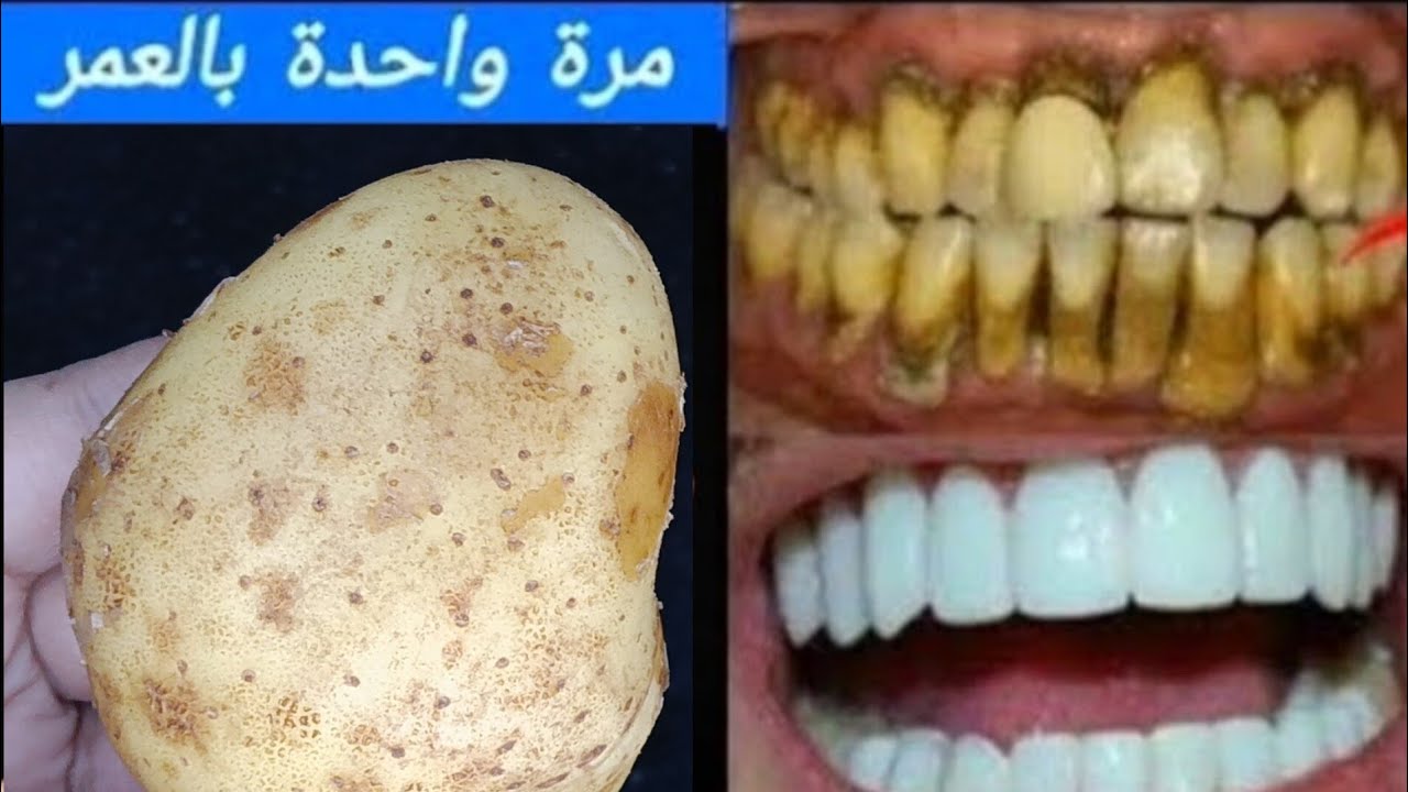 حبه بطاطس‼️قسما بالله لن تحتاج للذهاب لطبيب الأسنان مرة اخري‼️تبييض الأسنان في ثواني 