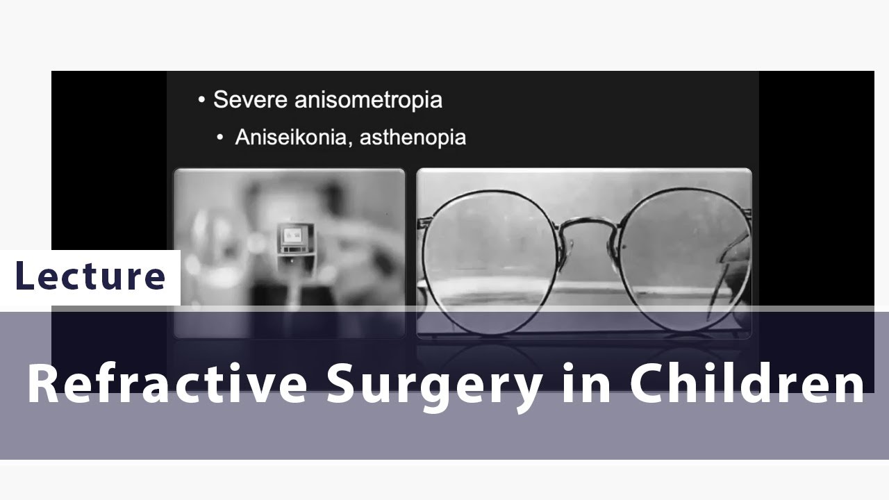 Refractive Surgery in Children