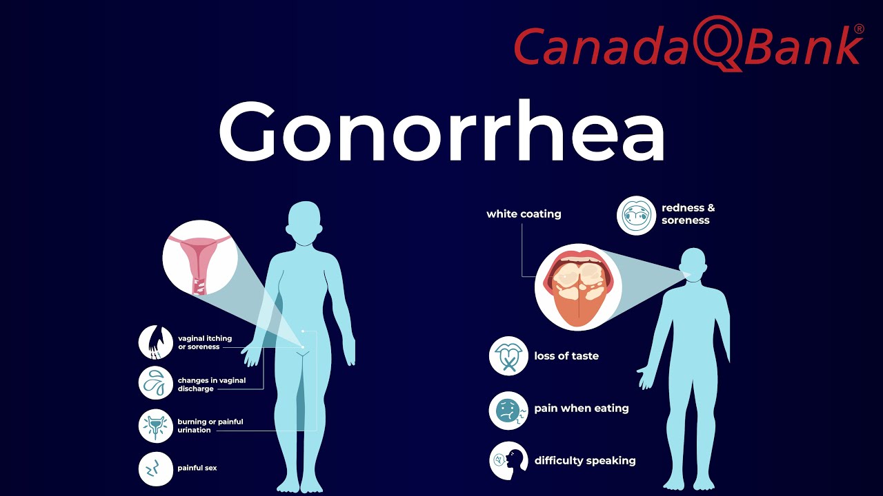 Gonorrhea Explained | Symptoms, Diagnosis & Treatment | CanadaQBank