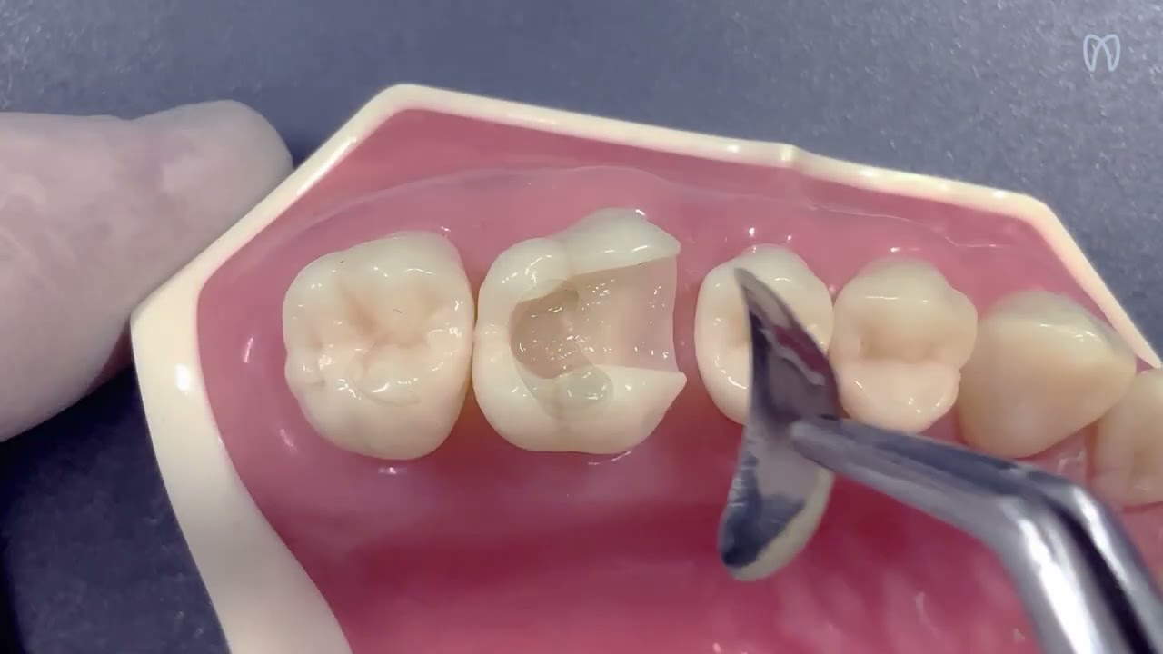 QuickmatFLEX matrizes seccionais de titânio ultramarino