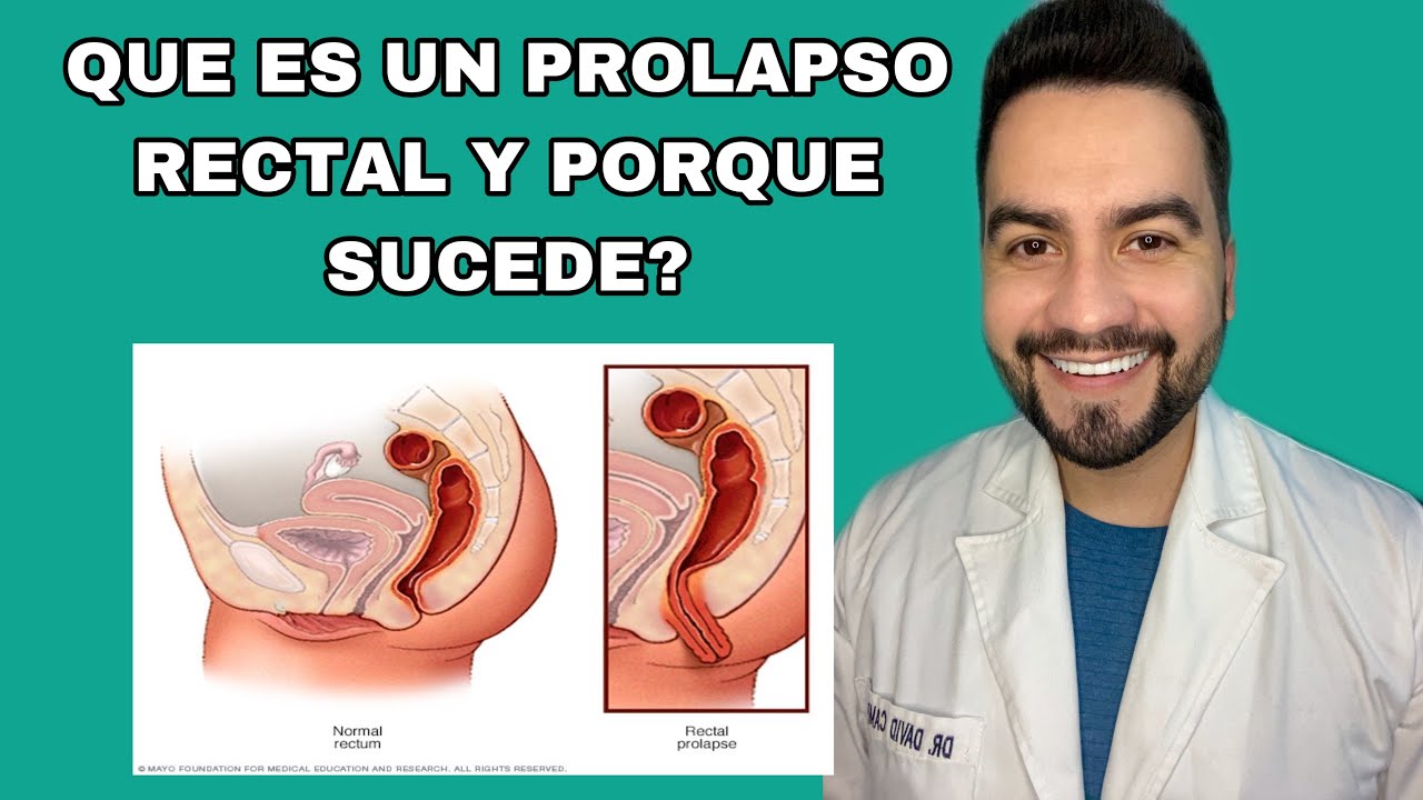TENGO PROLAPSO R3CT4L / QUE ES EL PROLAPSO Y CUALES SON SUS CAUSAS? | DR. DAVID CAMPOS