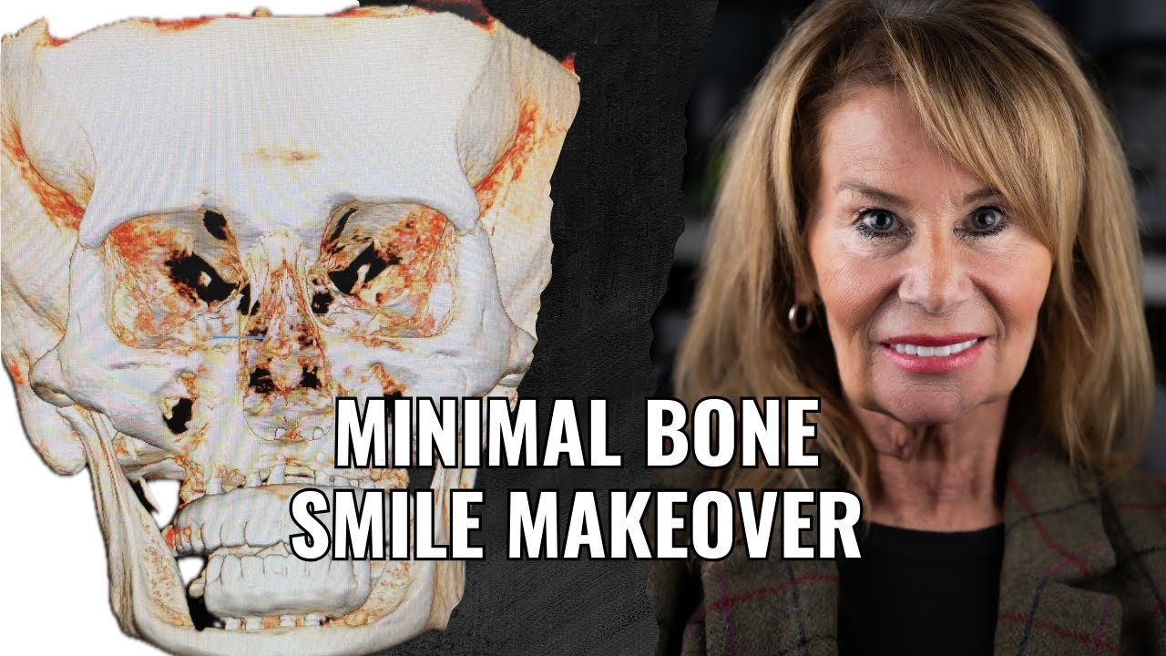 No Bone, No Hope? 3-on-6 Implants Proved Otherwise | 1 Week Post-Op