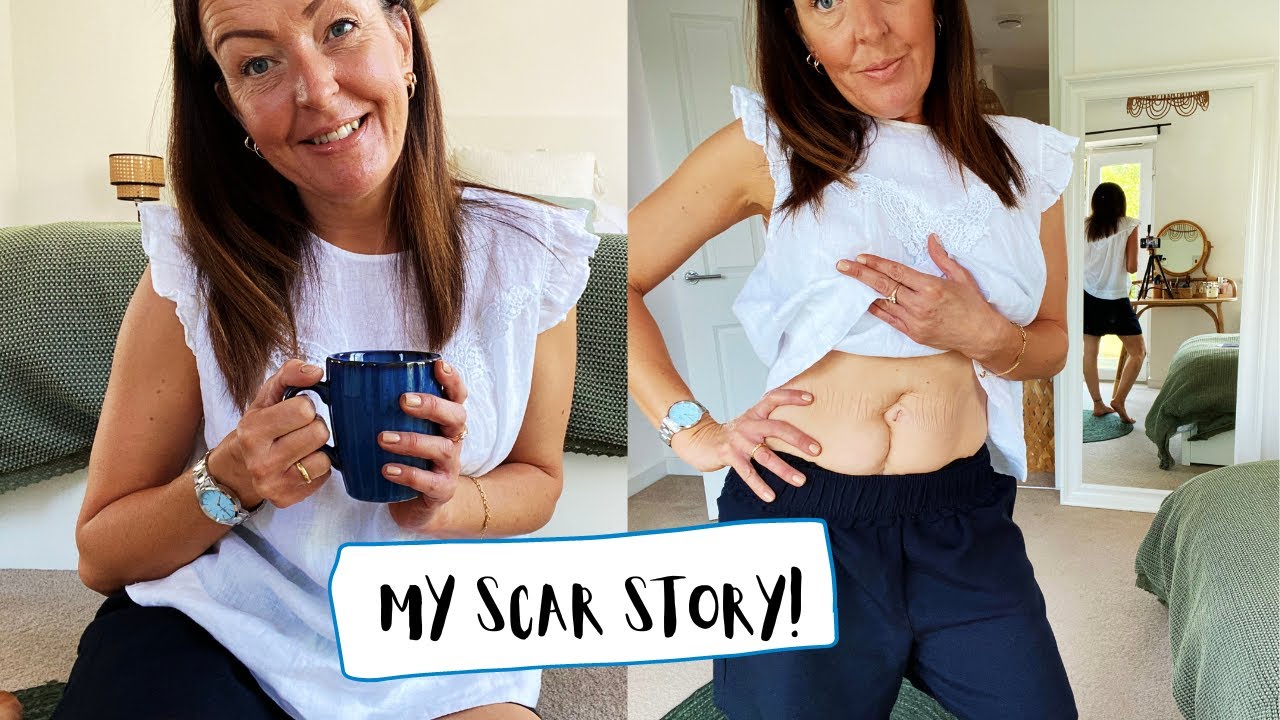 MY SCAR STORY