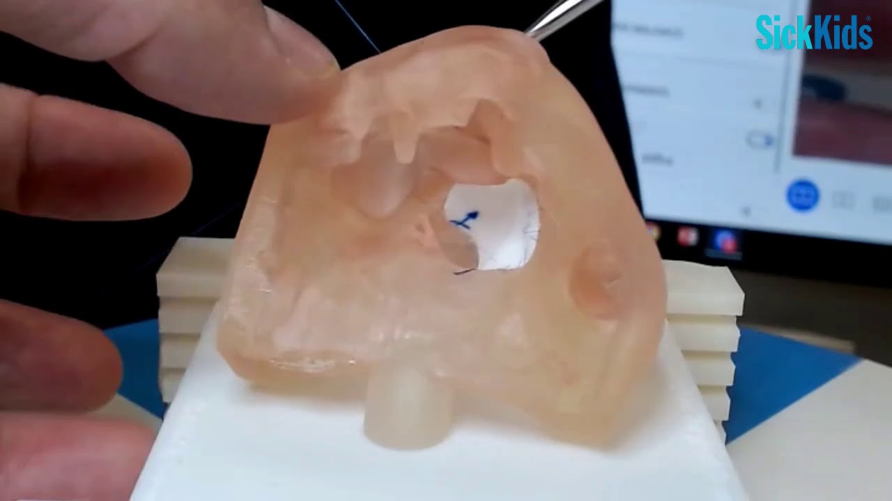 HOST - Ventricular Septal Defect (VSD) repair on a 3D-printed model - Dr Christoph Haller (FULL)