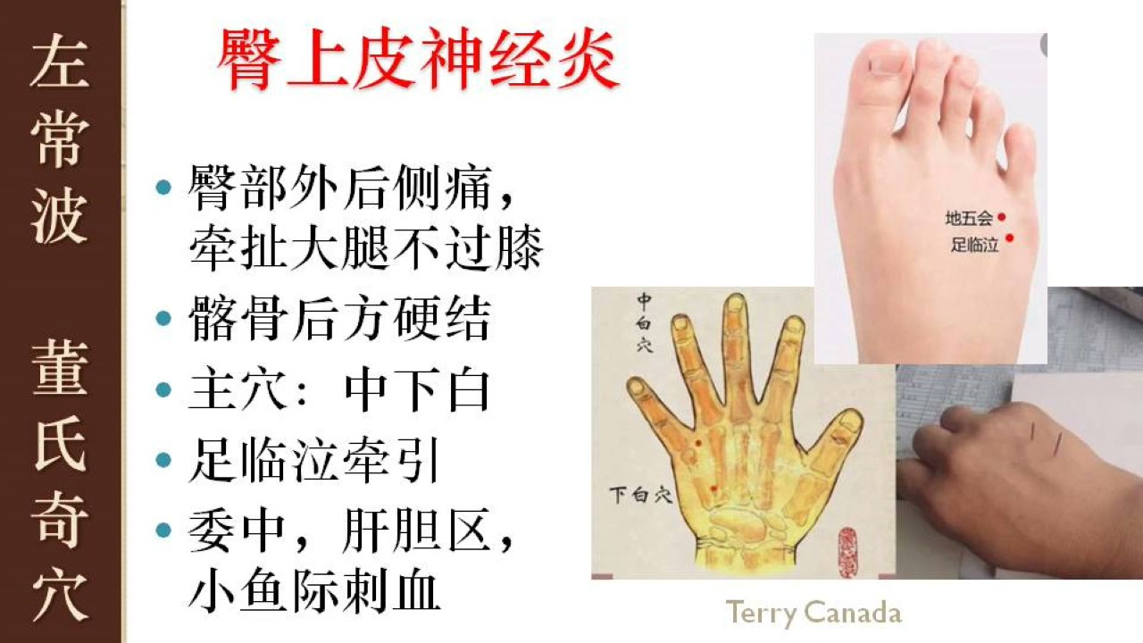 7.7 臀上皮神经炎 | 左常波 董氏针灸 刺血 解结  | Master Tung Acupuncture Points