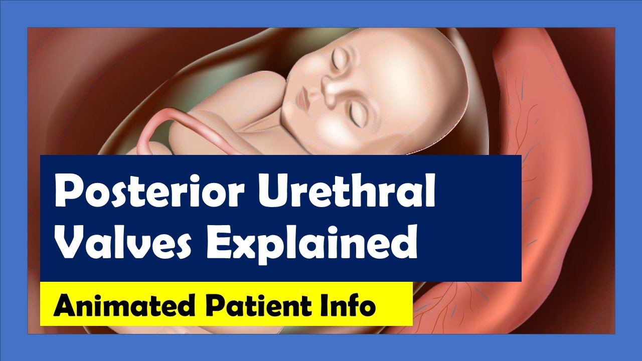 Posterior Urethral Valve (PUV) Explained
