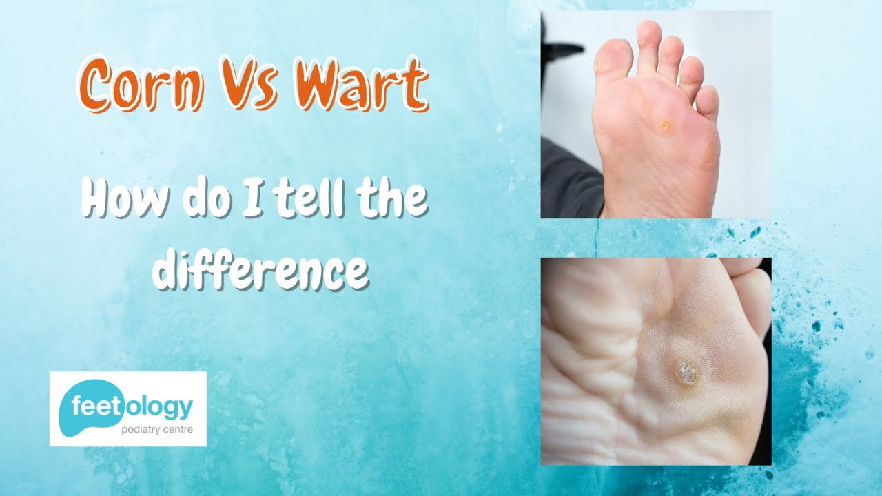 Corn Vs Wart - How Do I Tell The Difference