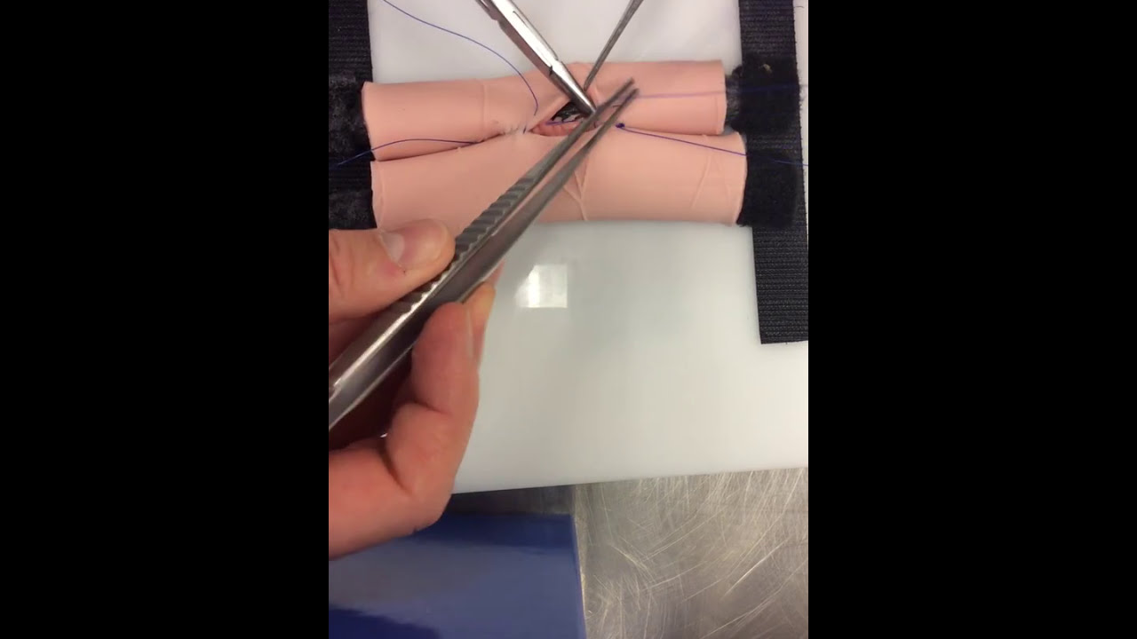 Open Handsewn two-layer side-side GI anastomosis