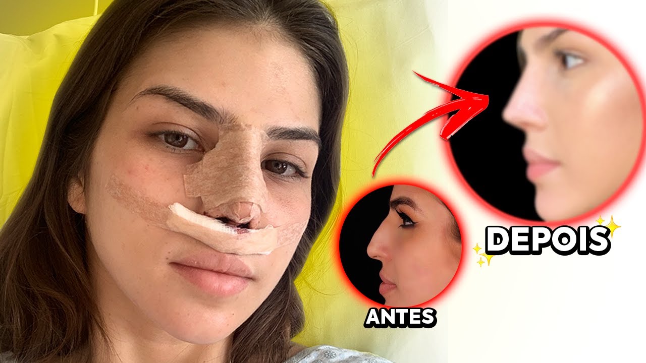 FIZ RINOPLASTIA!! **VEJA O RESULTADO**