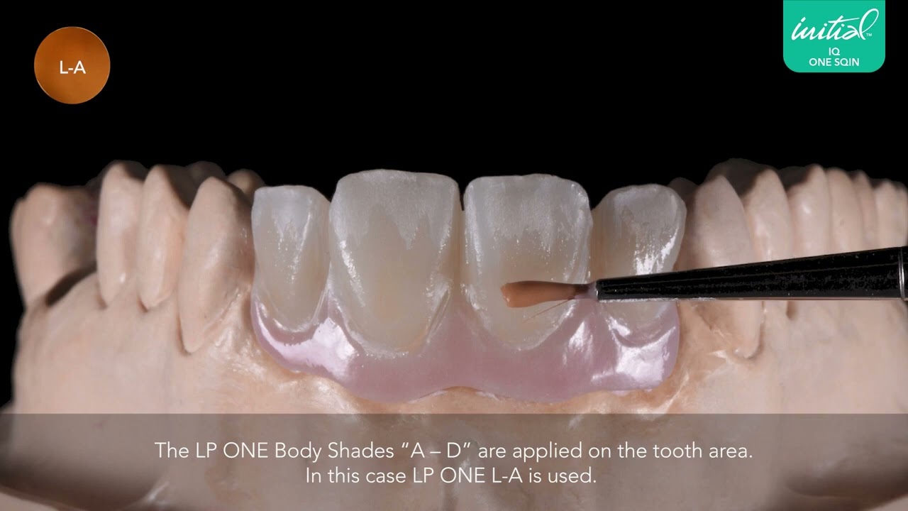 Characterization of your implant supported anterior bridge  Initial IQ ONE SQIN two step technique