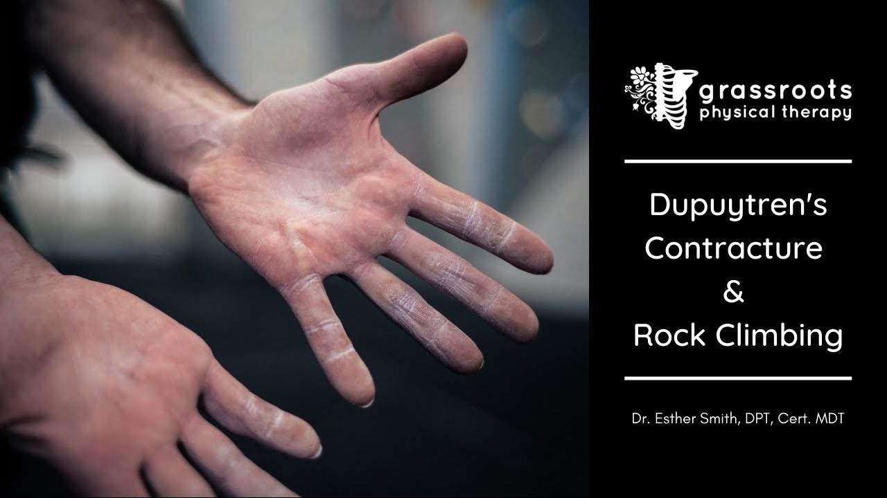 Dupuytren's Contracture and Rock Climbing