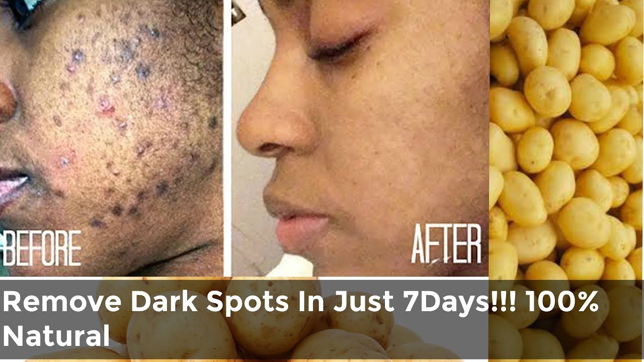 How to Remove Dark Spots, Hyperpigmentation in Just 7 Days! 100% Natural