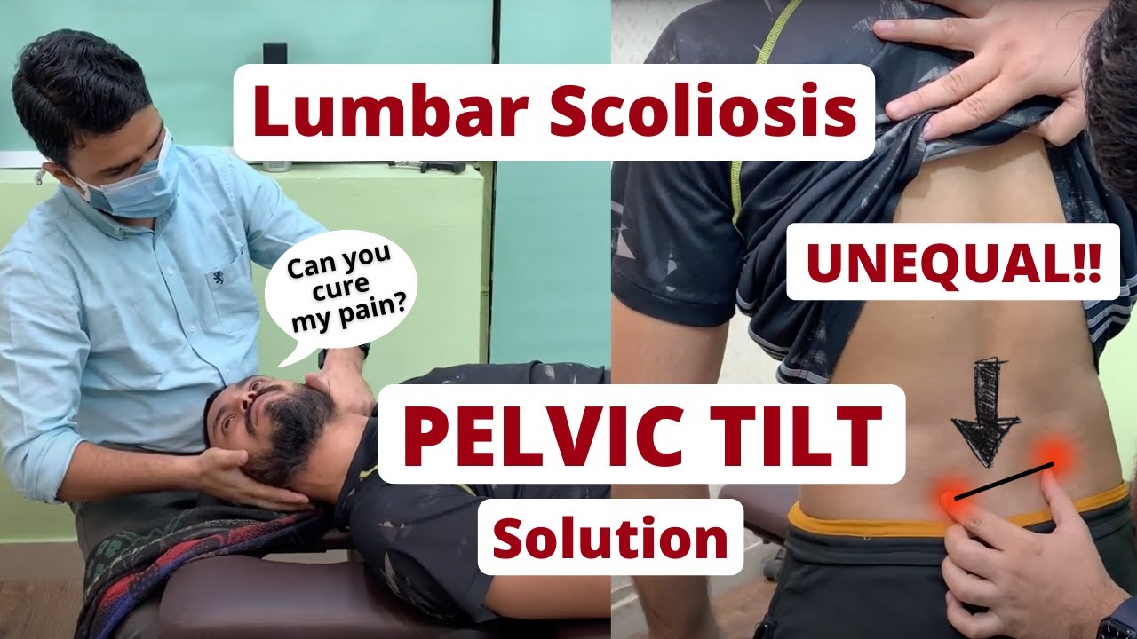 Intense *PAIN* cured by Chiropractor in India| Pelvic Tilt and Lumbar Scoliosis   Dr. Harish Grover