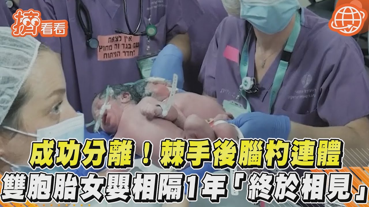 成功分離! 棘手後腦杓連體 雙胞胎女嬰相隔1年「終於相見」｜TVBS新聞｜擠看看