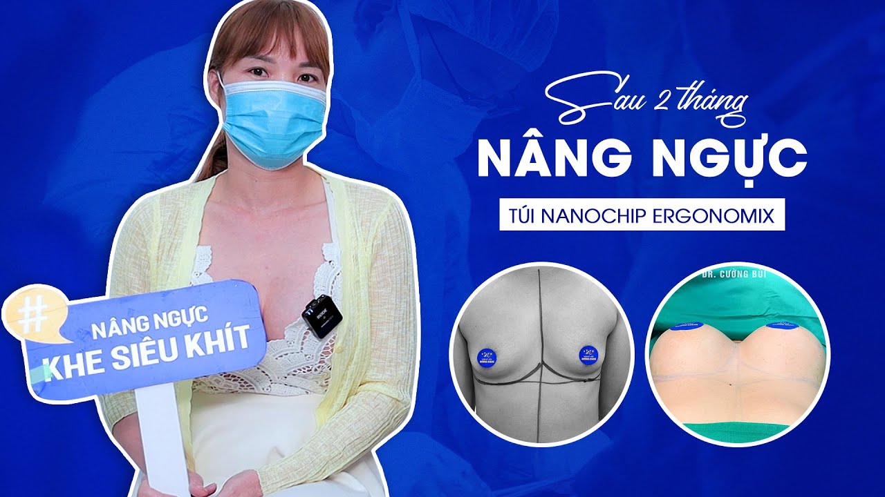 Kết quả sau 2 tháng nâng ngực túi nano chip ergonomix size 325cc