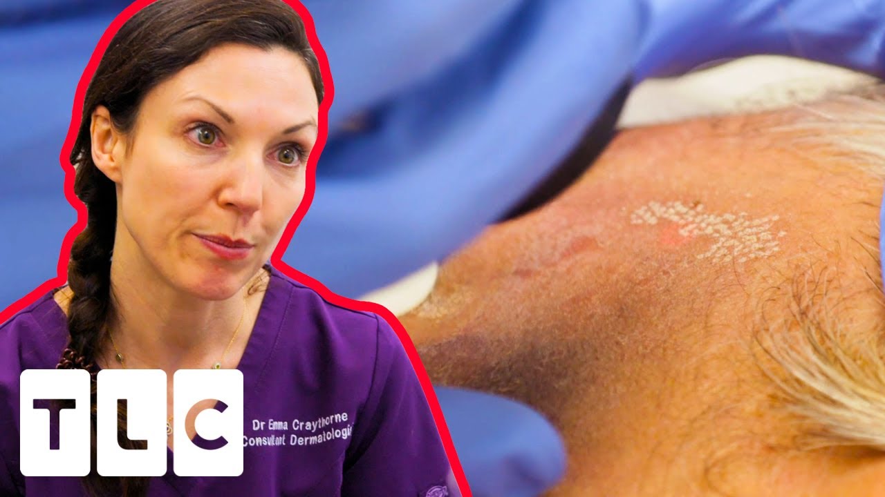 Mysterious Dark Spots Have Been Misdiagnosed! | The Bad Skin Clinic