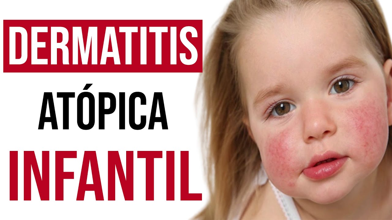 CONSEJOS para EVITAR y REDUCIR la DERMATITIS atópica en NIÑOS 👶🏼 ¿Cómo curarla?