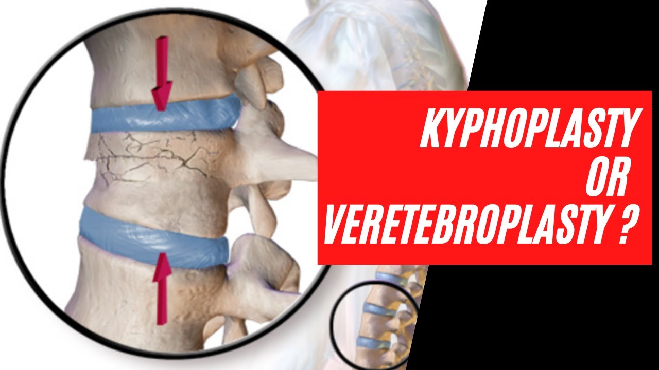 Vertebroplasty vs Kyphoplasty vs Spine Jack:  What's best for a fixing a broken bone in your back