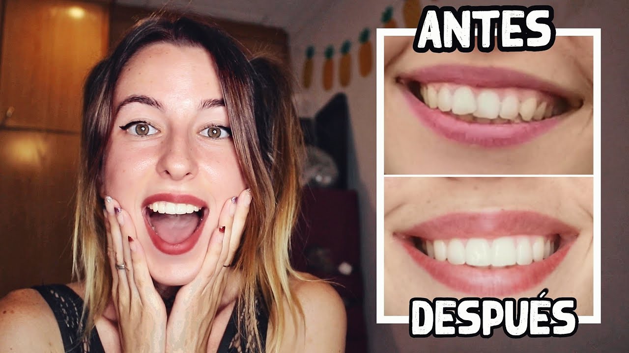 Mi experiencia con alineadores invisibles (Precio, dolor...)