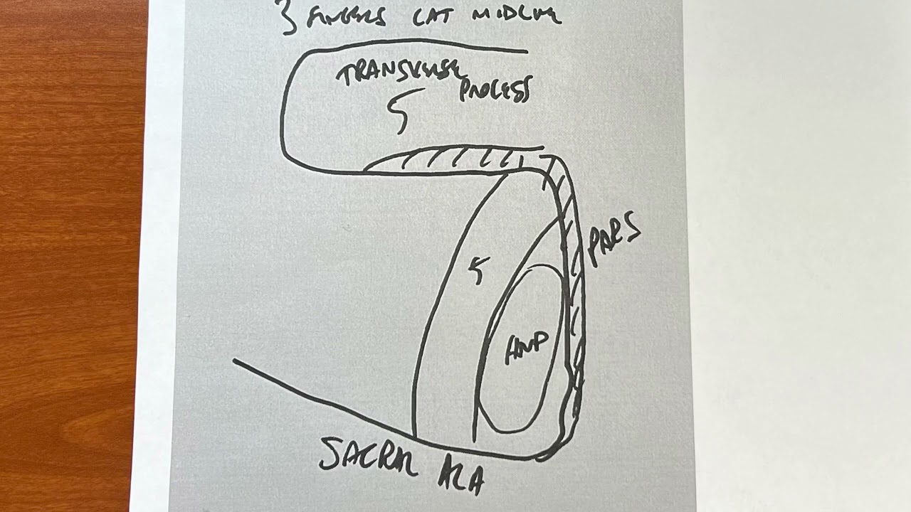Far Lateral disc herniation extraforamenal: Tips of the trade