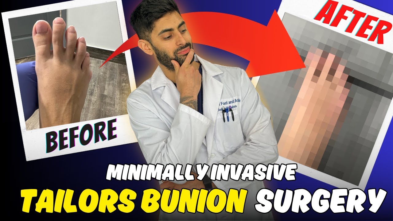 Desire: Fast Recovery from Tailors Bunion Surgery